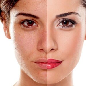 What should patients avoid before starting pigmentation treatment in Dubai?