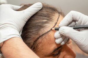 What to Expect from Hair Transplant Recovery