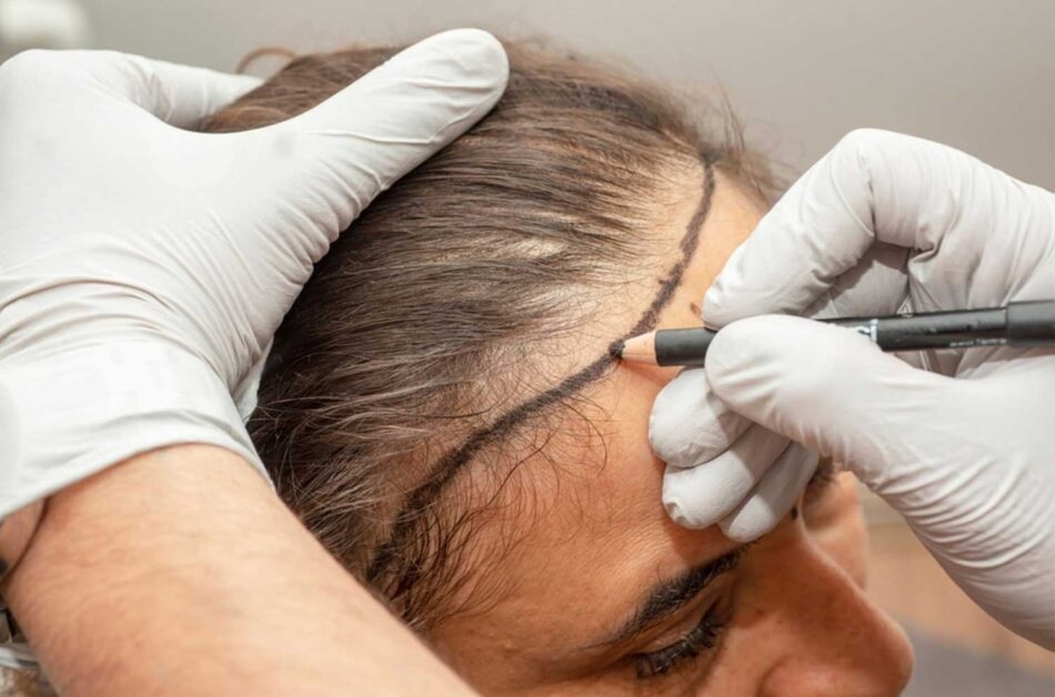 What to Expect from Hair Transplant Recovery