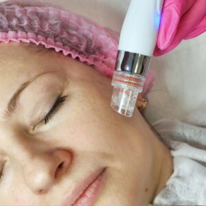 Mesotherapy Treatment Benefits You Didn’t Know About Yet