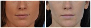 What Happens After Botox for Jawline? Before & After