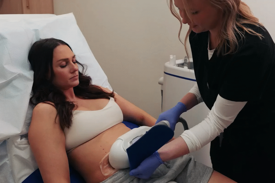 CoolSculpting Unlocks Toned Curves With Safe, Fast Action