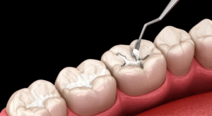 What Goes Into Tooth Filling Cost and Why It Matters