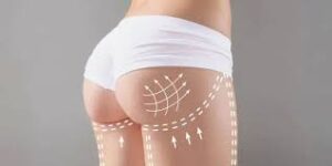 تأثير العمر ونمط الحياة على اختيار حقن السكلبترا مقابل حقن الراديس