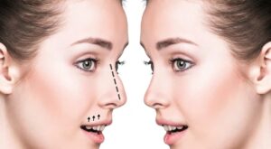 Why Are the Best Doctors in Dubai Preferred for Endoscopic Septoplasty?