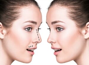 Why Are the Best Doctors in Dubai Preferred for Endoscopic Septoplasty?