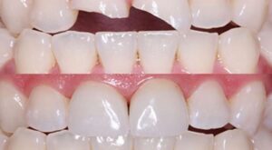 Fractured Tooth Pain Relief & Treatment Options