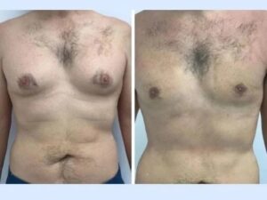 How the Best Doctors in Dubai for Gynecomastia Customize Treatment Plans