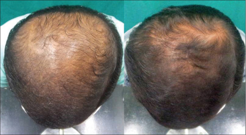 Finasteride 1mg Price for Hair Loss Treatment