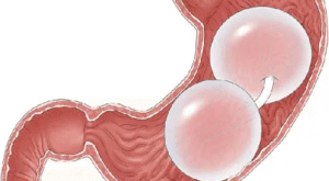 Why Gastric Balloon Placement in Dubai Is Worth Considering