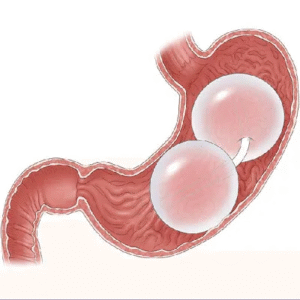 Why Gastric Balloon Placement in Dubai Is Worth Considering