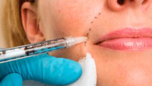 Can Skin Booster Injection in Dubai Treat Acne Scars?
