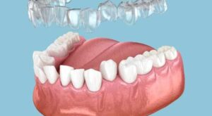 invisalign Newbury