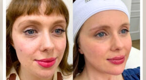 IPL Laser in Manchester: Complete Guide to Treating Redness, Pigmentation & Sun Damage