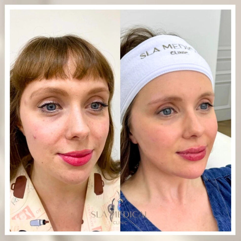 IPL Laser in Manchester: Complete Guide to Treating Redness, Pigmentation & Sun Damage