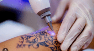 Safe and Efficient Laser Tattoo Removal in Mumbai