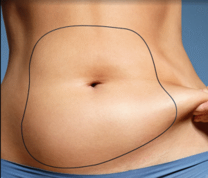 Liposculpture in Dubai – Step-by-Step Overview