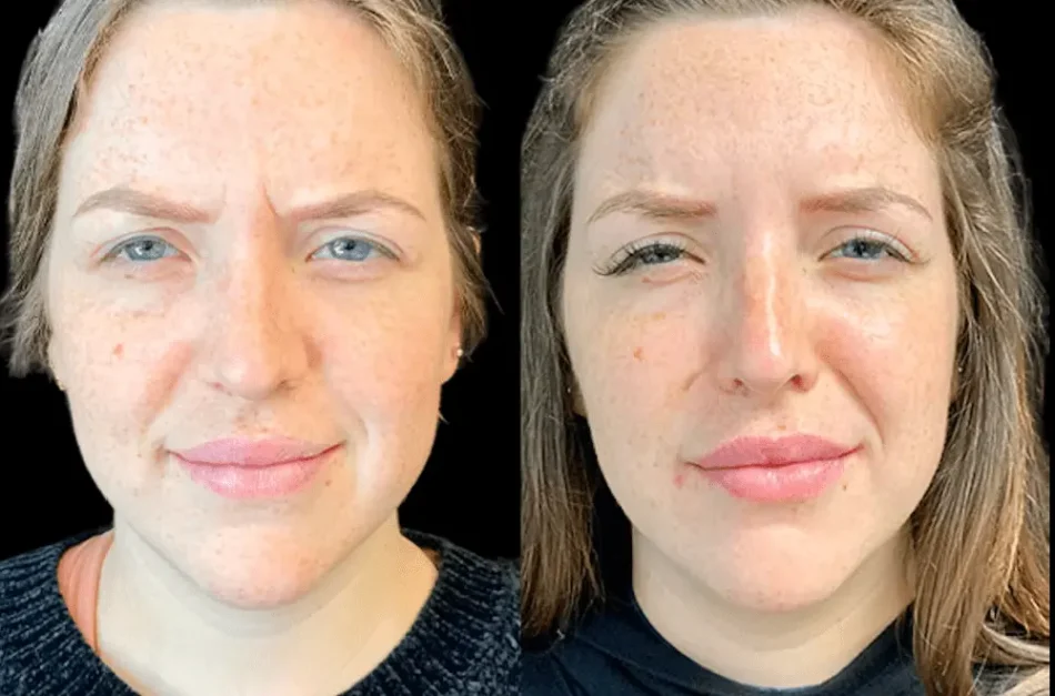 Seasonal Guide: When Is the Best Time to Get Botox in Dubai?