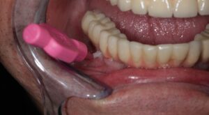 Why Choose Dental Crowns and Bridges for Missing Teeth