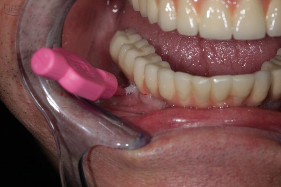 Why Choose Dental Crowns and Bridges for Missing Teeth