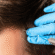 Best PRP Hair Treatment for Early-Stage Hair Loss