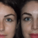Nose deviated septum Surgery in Dubai