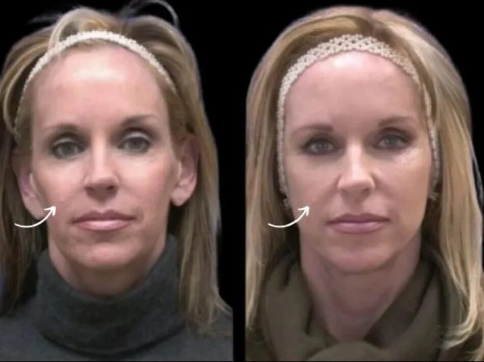 Expert Tips to Maximize Results from Sculptra Fillers Treatments in Dubai