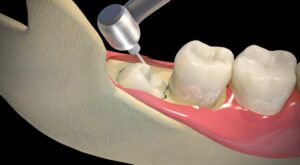 Tooth Extraction Cost After Crown Damage