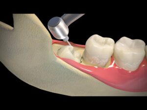 Tooth Extraction Cost After Crown Damage
