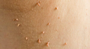Are Skin Tags Infectious? What You Should Know