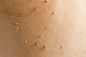 Are Skin Tags Infectious? What You Should Know