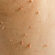Are Skin Tags Infectious? What You Should Know