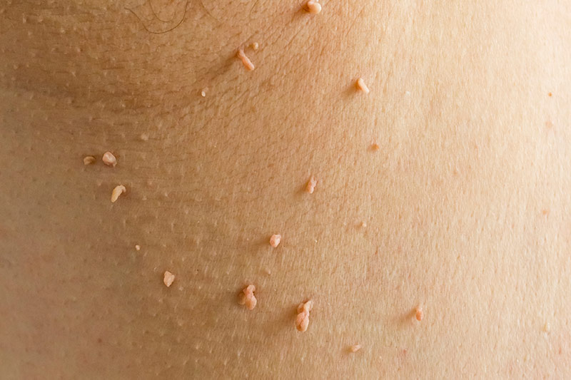 Are Skin Tags Infectious? What You Should Know
