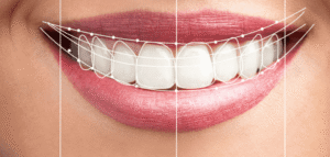 Hollywood Smile Makeover in Dubai – Get the Perfect Smile
