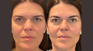 Non-Surgical Facial Rejuvenation: The Rise of Thread Lift in Dubai