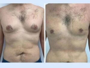 Best Gynecomastia Surgeon in dubai: How Surgeons Achieve Natural Results