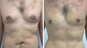 Best Gynecomastia Surgeons in dubai: Who Deliver Natural-Looking Chests