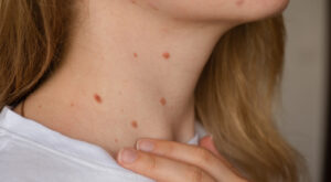 Are Skin Tags Contagious? Understanding the Real Cause