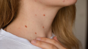 Are Skin Tags Contagious? Understanding the Real Cause
