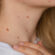 Are Skin Tags Contagious? Understanding the Real Cause