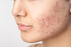 How Many Laser Acne Treatment Sessions Are Needed for Clear Skin?