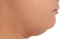 How Double Chin Removal Gives You Quick Relief from a Heavy Jawline