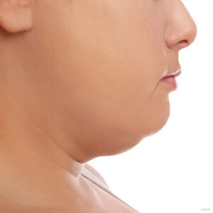 How Double Chin Removal Gives You Quick Relief from a Heavy Jawline