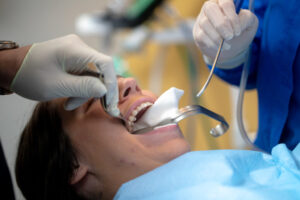 Say Goodbye to the Ache! The No-Fuss Guide to Wisdom Teeth Removal in Hammond, IN
