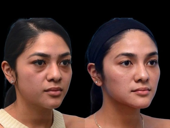 Understanding the Causes of Dark Circles and Available Dark Circles Treatments in Dubai