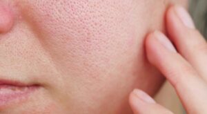 Laser Skincare Treatments for Enlarged Pores