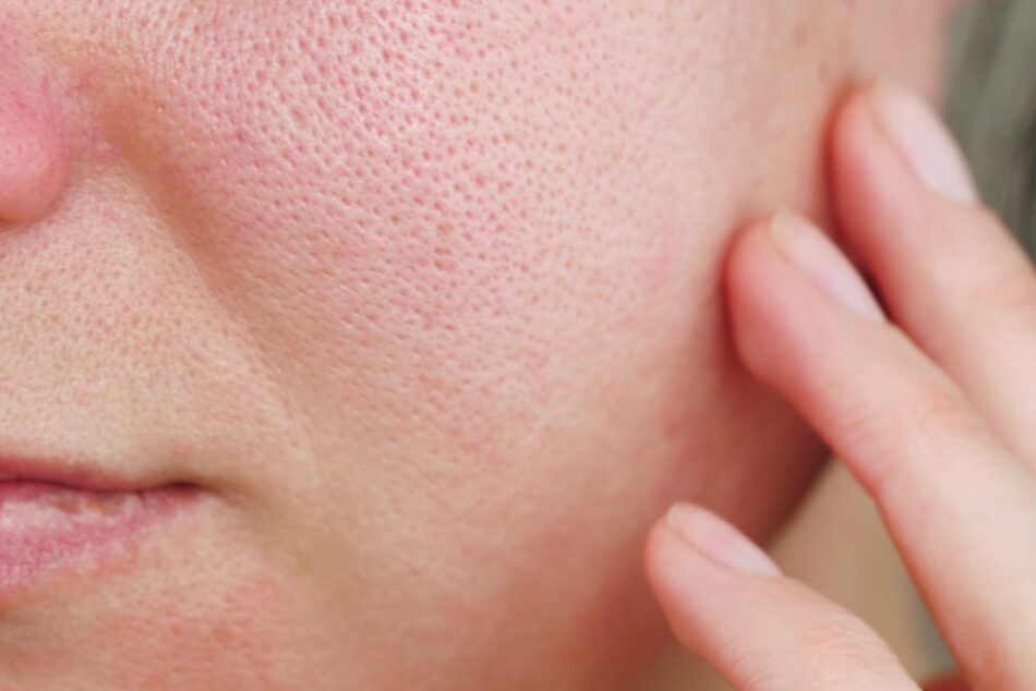 Laser Skincare Treatments for Enlarged Pores