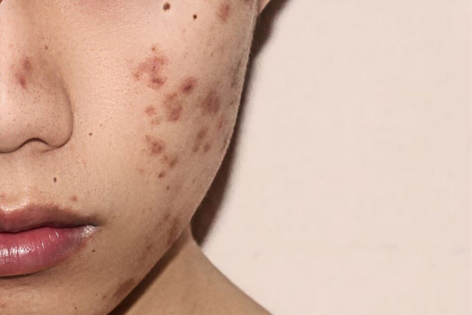 Acne Removal Dubai: AI-Powered Skincare Trends