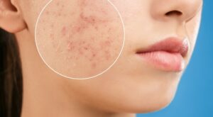Acne Removal Dubai: Post-Treatment Care Tips
