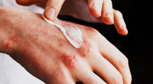 Allergy Treatment Market Growth Accelerates as 40% of World Faces Allergic Conditions